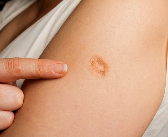 Here’s The Truth Behind This Scar On People’s Upper Left Arm
