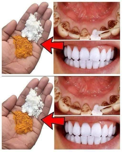 Natural Remedies with Cloves and Bay Leaves for a Brighter Smile… Natural Remedies with Cloves and Bay Leaves for a Brighter Smile…