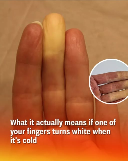What it actually means if one of your fingers turns white when it’s cold What it actually means if one of your fingers turns white when it’s cold