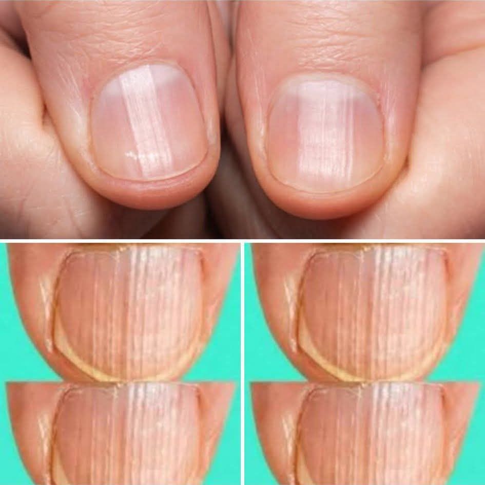 Rippled fingernails reveal secrets of possible disease Rippled fingernails reveal secrets of possible disease