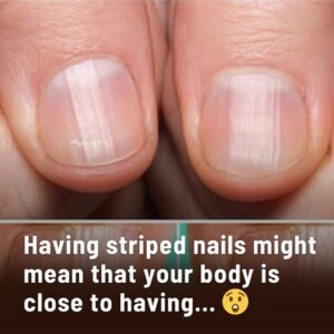 Rippled Fingernails: A Window to Your Health – What Your Nails Might Be Trying to Tell You