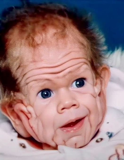 The boy born with a wrinkled body shocked the world… The boy born with a wrinkled body shocked the world…