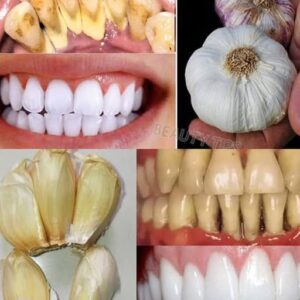 Natural Teeth Whitening – Say Goodbye to Yellowing and Tartar Natural Teeth Whitening – Say Goodbye to Yellowing and Tartar