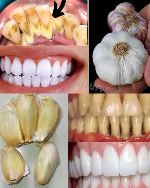 Natural Teeth Whitening – Say Goodbye to Yellowing and Tartar Natural Teeth Whitening – Say Goodbye to Yellowing and Tartar