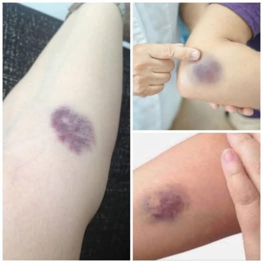 Understanding and Managing Those Painful Red Bumps Understanding and Managing Those Painful Red Bumps