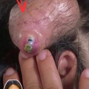 Best 15 Tips For Squeezing Blackheads On Nose
