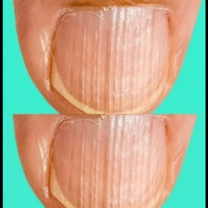 Rippled fingernails reveal secrets of… Rippled fingernails reveal secrets of…