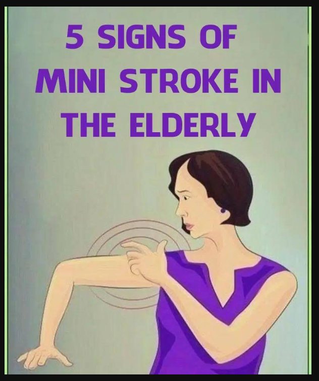 Mini Str0ke in the Elderly: Common and Unusual Symptoms