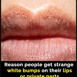 What Are Those White Bumps That Can Appear On Your Private Parts and What Causes Them?