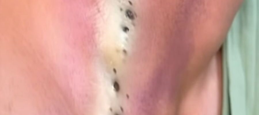 Blackheads – Pimple