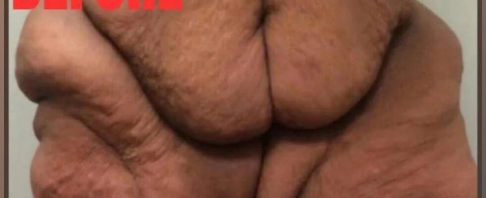 World’s heaviest woman who weighed 50 stone now unrecognisable