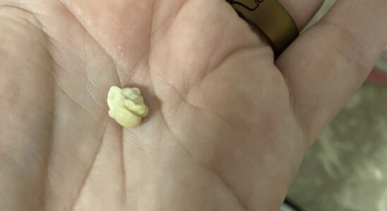Person Stunned After Waking Up With This Rolling Around In Their Mouth