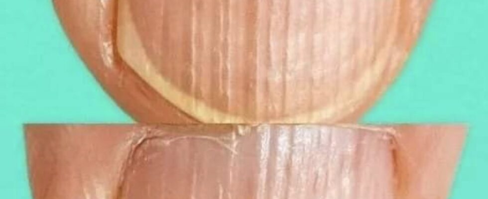 Doctor Explains What It Means If You Have Ridges On Your Fingernails