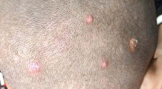 Found these bumps on my son’s scalp