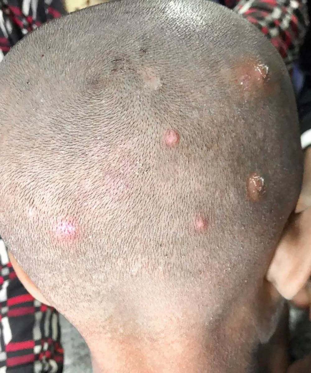 Found these bumps on my son’s scalp