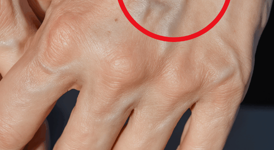 When to Worry About Veins That Appear Out of Nowhere