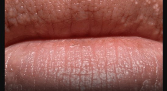 What Are Those White Bumps That Can Appear?