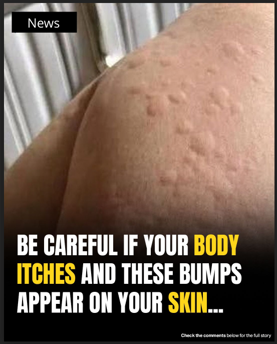 Surprising Causes Of Hives Revealed — What May Be Triggering Your Skin Reaction