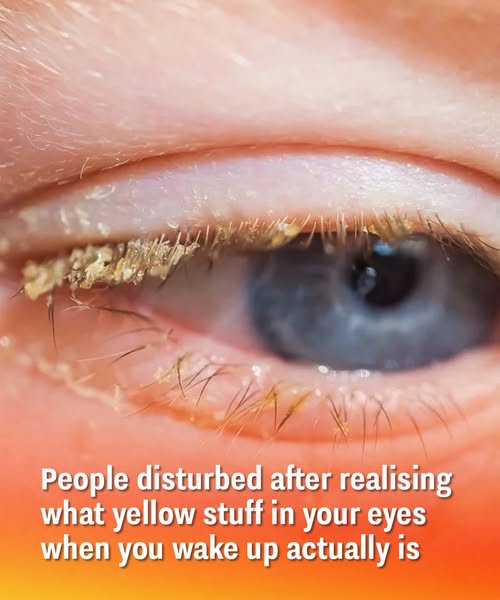 What yellow stuff in your eyes when you wake up actually is!