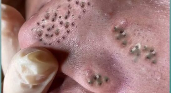 Tips For Squeezing Blackheads On Nose