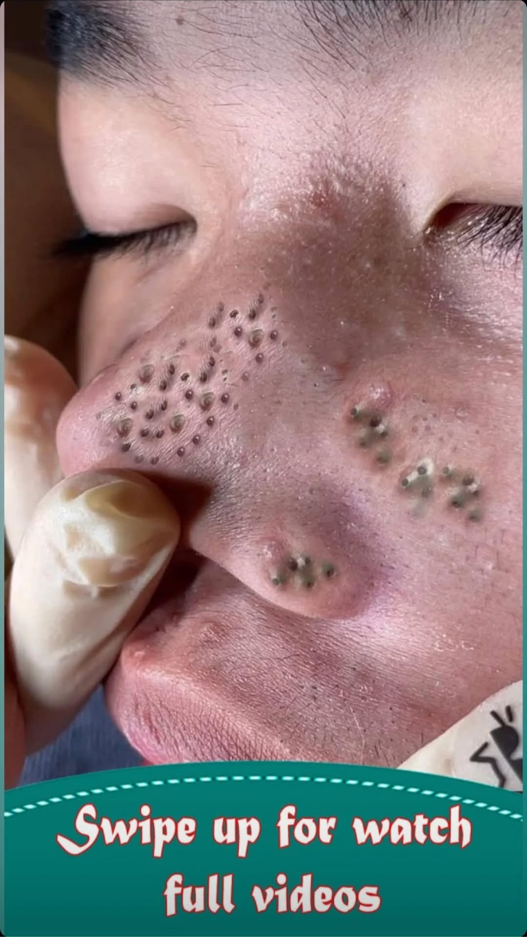Tips For Squeezing Blackheads On Nose