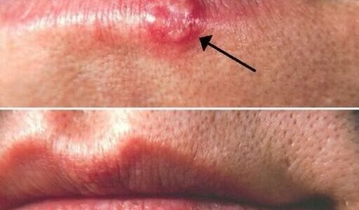 Most People Have Had or Have This Cold…