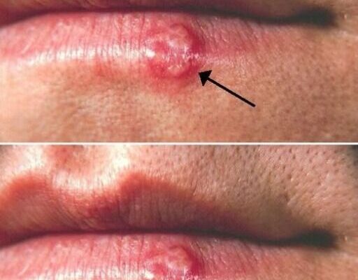 Most People Have Had or Have This Cold…