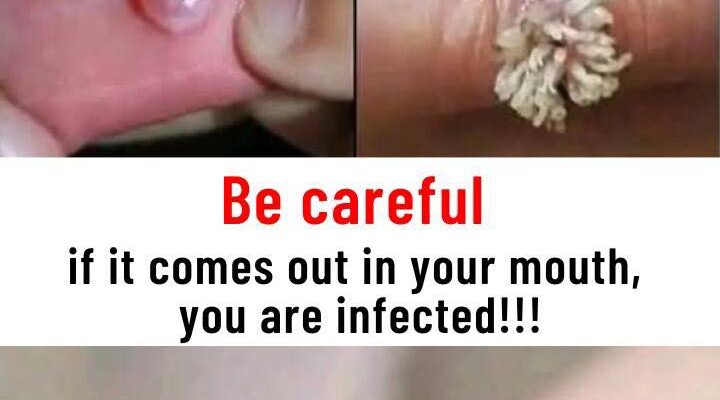 Be very careful if it comes out in your mouth, you are infected