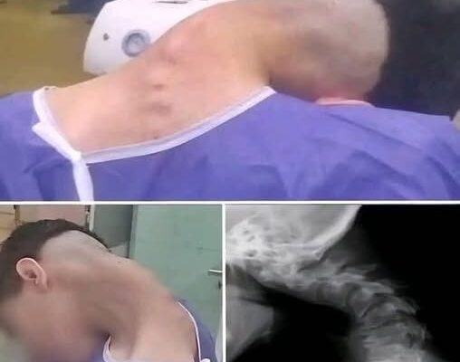 CRUSHED BY IMPACT: FALLING OBJECT CAUSES RARE FATAL NECK FRACTURE IN 18-YEAR-OLD WORKER
