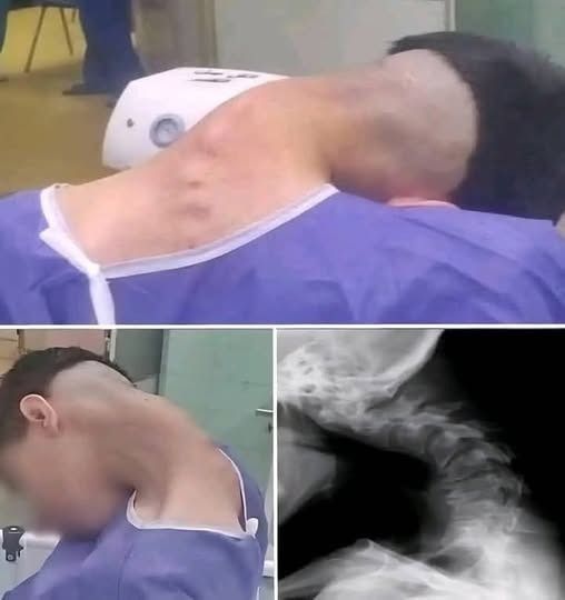 CRUSHED BY IMPACT: FALLING OBJECT CAUSES RARE FATAL NECK FRACTURE IN 18-YEAR-OLD WORKER