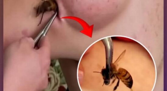 10 Bug Bites Anyone Should Be Able to Identify and…