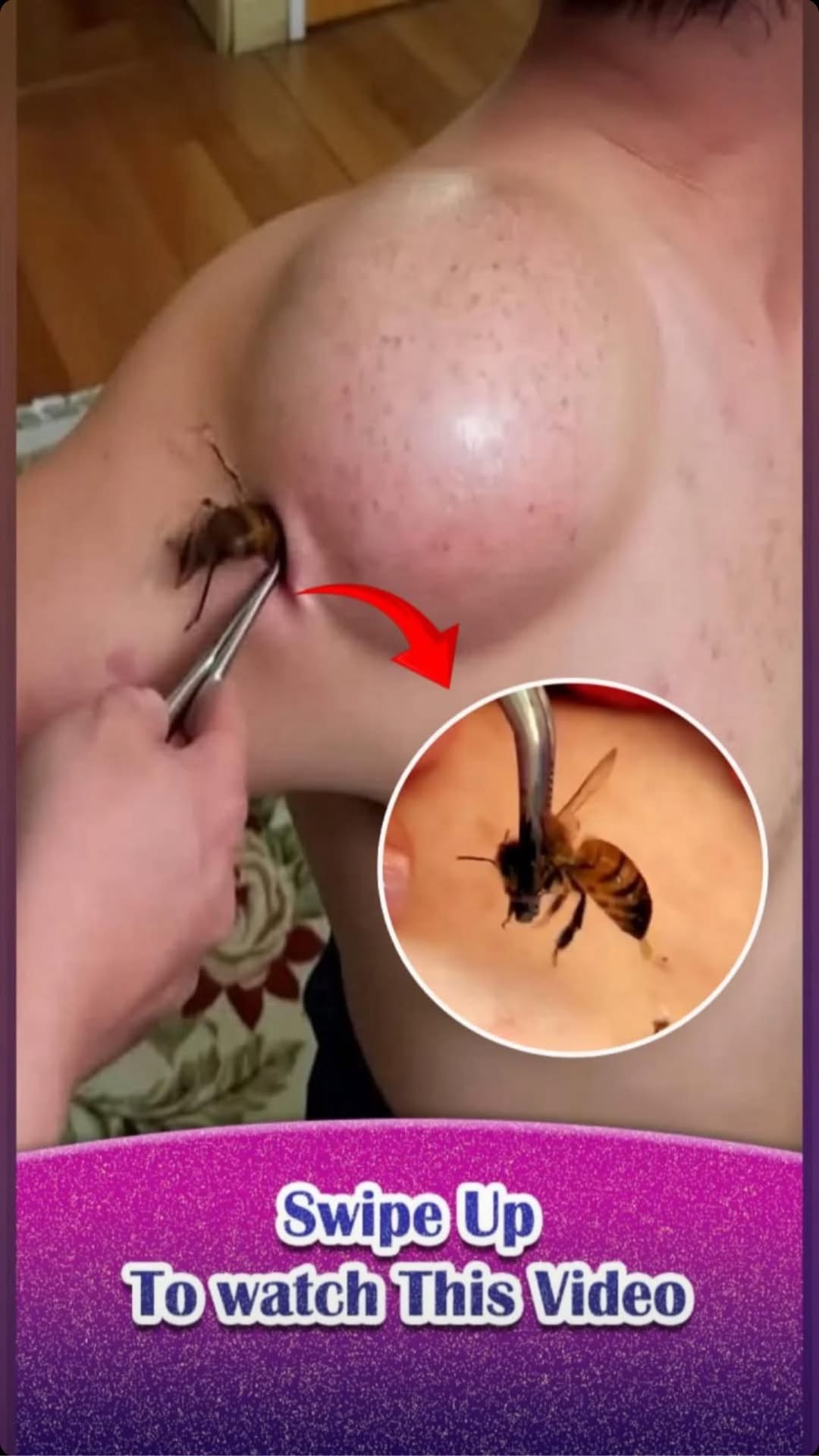 10 Bug Bites Anyone Should Be Able to Identify and…