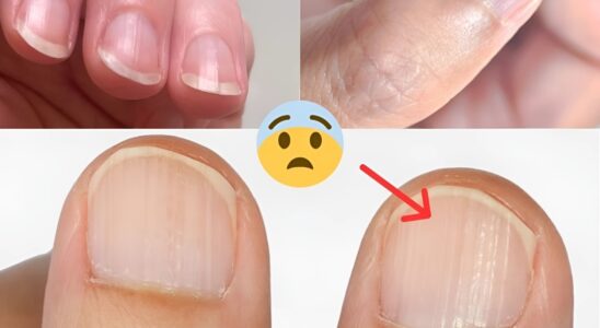 Doctor Reveals 7 Health Issues Hidden in Your Nails