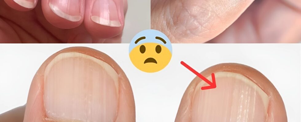 Doctor Reveals 7 Health Issues Hidden in Your Nails