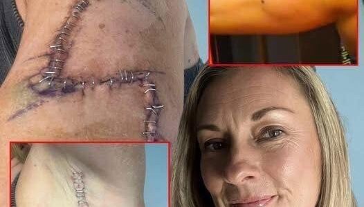 TG She Thought It Was Just A Mole… 77 Stitches Later, Doctors Told Her The Truth…