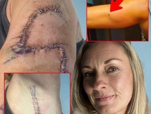 TG She Thought It Was Just A Mole… 77 Stitches Later, Doctors Told Her The Truth…