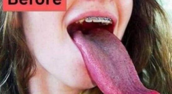What White Tongue Is, and What to Do About It