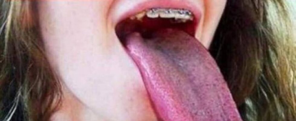 What White Tongue Is, and What to Do About It