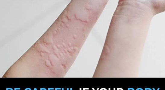 Surprising Causes Of Hives Revealed
