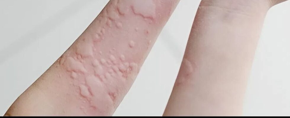 Surprising Causes Of Hives Revealed