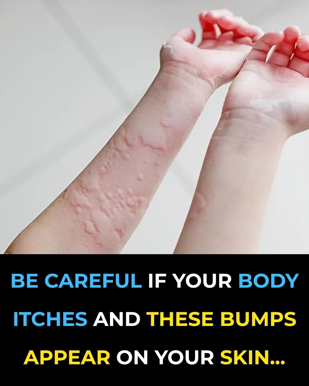 Surprising Causes Of Hives Revealed