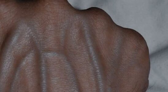 5 Health Conditions That Can Cause Visible Veins