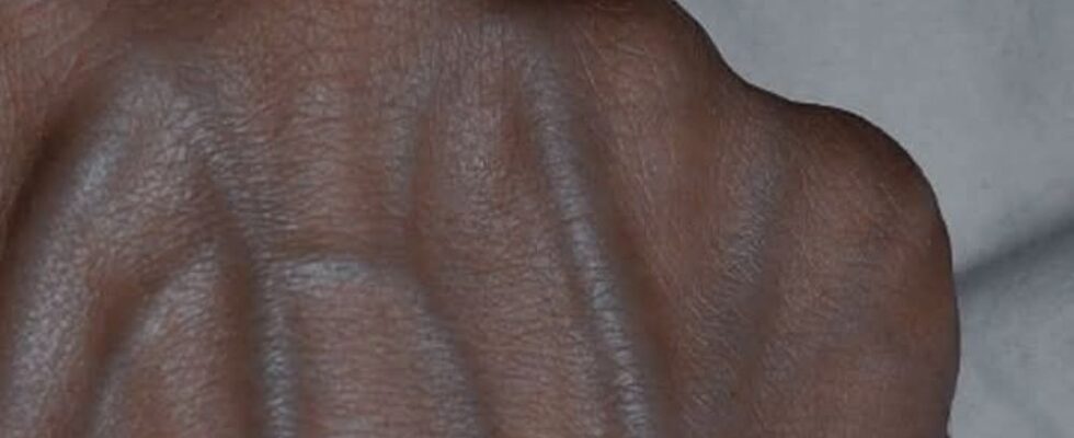 5 Health Conditions That Can Cause Visible Veins