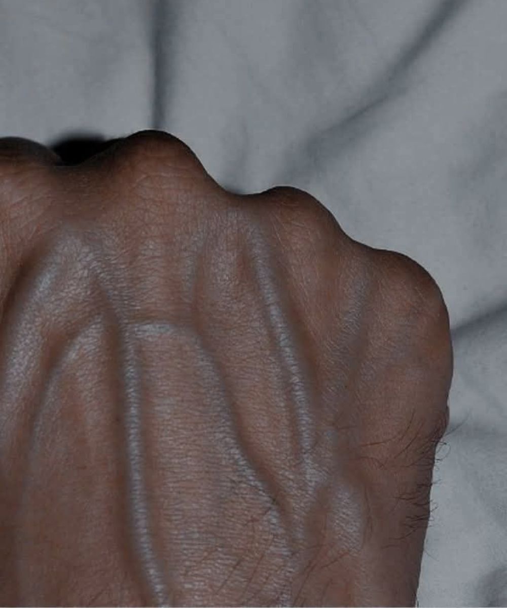 5 Health Conditions That Can Cause Visible Veins