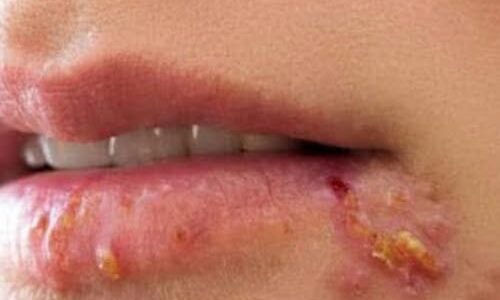 If You See This Appearing on Your Lips