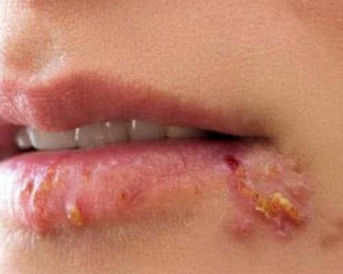 If You See This Appearing on Your Lips