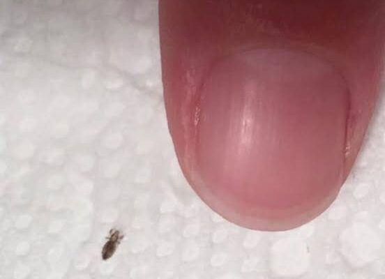 If you find this bug in your hair. How to get rid of them and stop them coming back