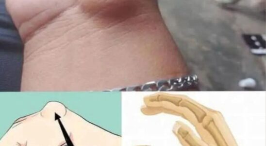 If You Get These Bruises on Your Body, It Might Mean Something Serious