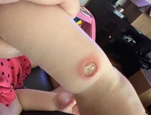 Unusual Case of Sweet Syndrome Triggered by New Inhaler Therapy in Primary Care