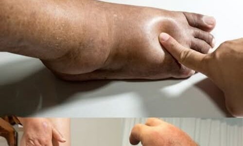 Swollen Hands & Feet?